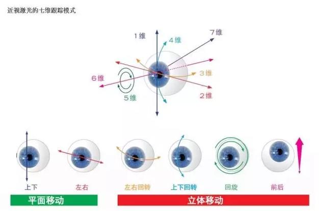 近视矫正出问题的大部分是全飞秒,飞秒近视矫正教程