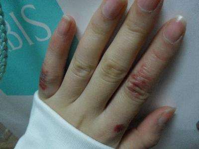 脚上冻疮怎么办,根治冻疮特效药