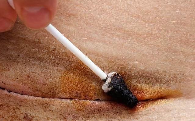 剖宫产孕妇伤口怎么处理,产妇剖宫产后刀口疼怎么缓解