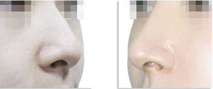 不同风格的鼻子,不同鼻型的矫正方法