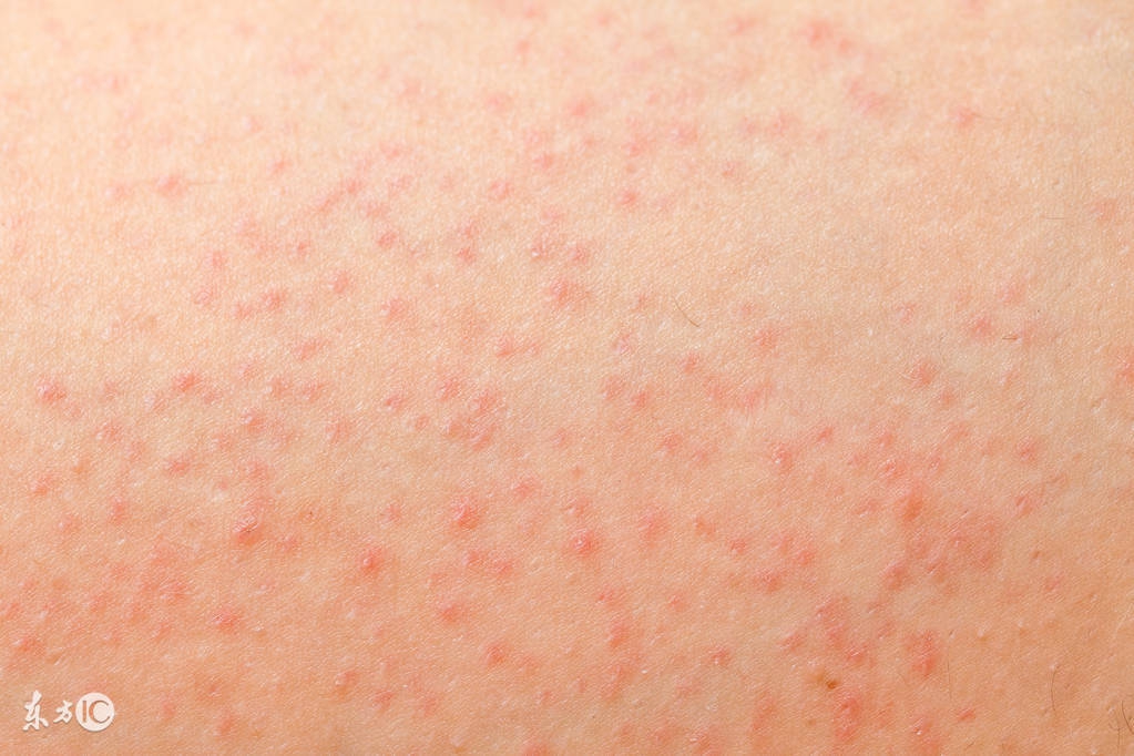 毛囊炎怎么护理头发,毛囊炎护理措施有哪些