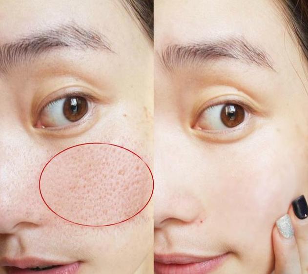 女生脸毛孔大怎样办,女生面颊毛孔粗大怎么办