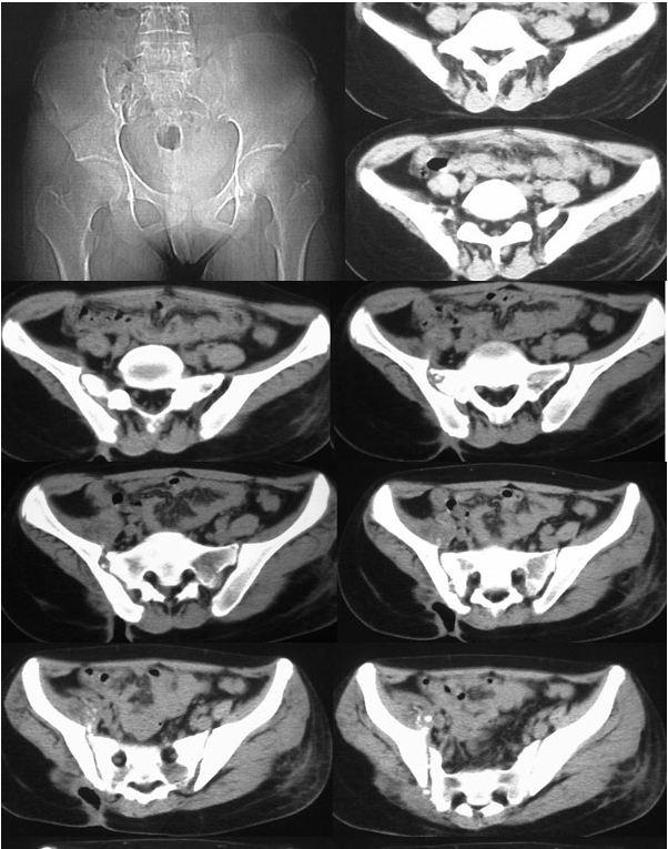 为什么臀部会发育不良,小孩臀部肌肉松弛