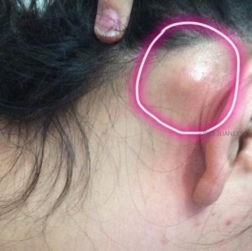 宝宝耳朵后面长了个疙瘩怎么回事,耳朵后面长了个疙瘩是怎么回事