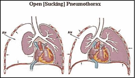 跑步左胸岔气了怎么快速缓解,跑步导致的气胸要怎么处理
