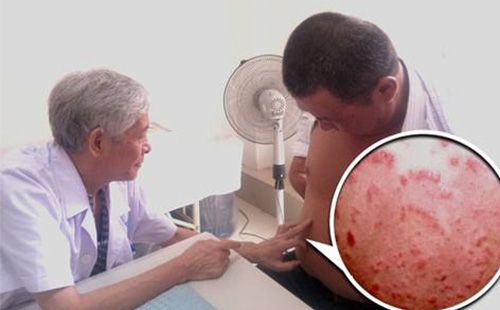 牛皮癣不是遗传的可以痊愈吗,爸爸后天有牛皮癣会遗传孩子吗