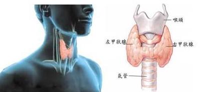 甲状腺结节是否被过度治疗了,当心别让甲状腺结节发展成癌