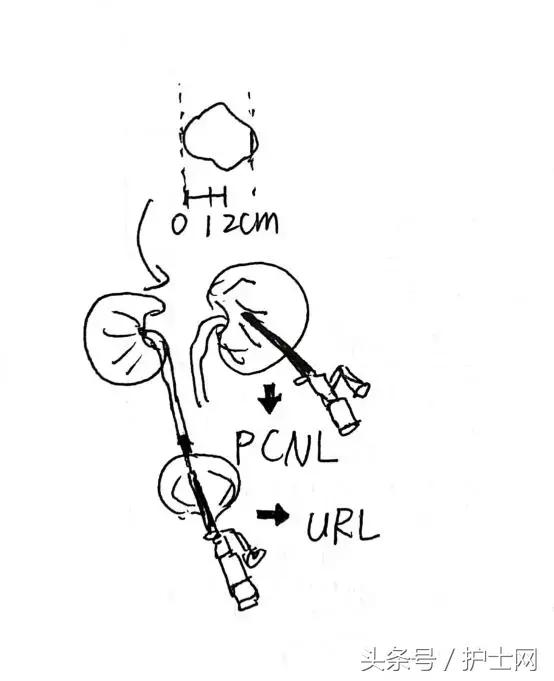 经常跳跳就可以将肾结石蹦出来吗,经常跳跳有助于长高吗