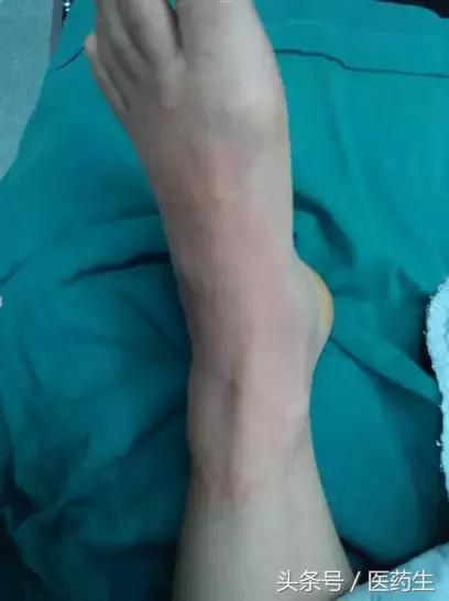 遇到过敏性休克我们应该做什么,预防接种过敏性休克处置原则