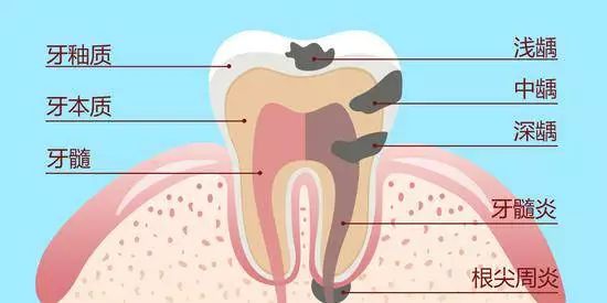 蛀牙是不是虫子钻的,蛀牙是真的因为有虫子吗