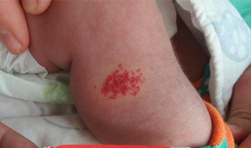 正规治疗婴幼儿血管瘤什么方法好,婴幼儿血管瘤怎么治疗效果好