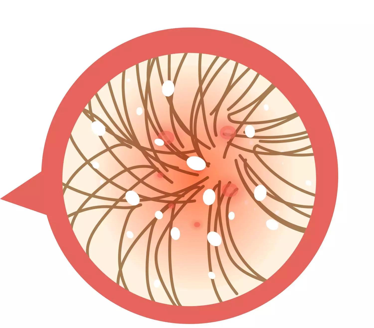 头皮黄金微针效果,头皮上白痘