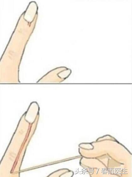 长倒刺怎么处理最好,长倒刺缺什么营养