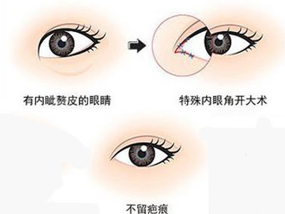 做双眼皮开眼角和不开眼角的区别,想要做双眼皮有什么注意事项吗