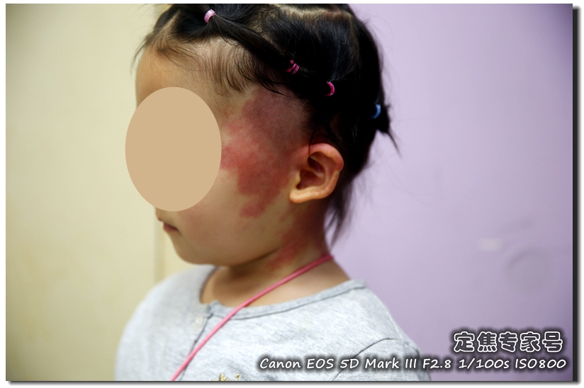 脸上大面积起红斑怎么回事,脸上红斑怎么消除最快