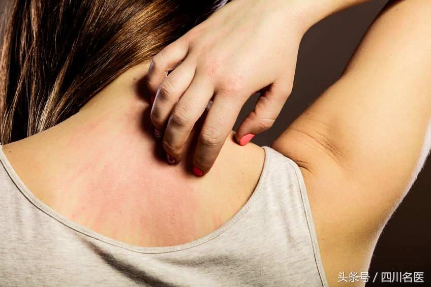 突发红疹紧急措施,身体大面积红疹甚至过敏性休克