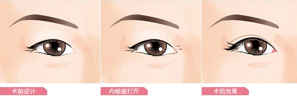 做双眼皮开眼角和不开眼角的区别,想要做双眼皮有什么注意事项吗