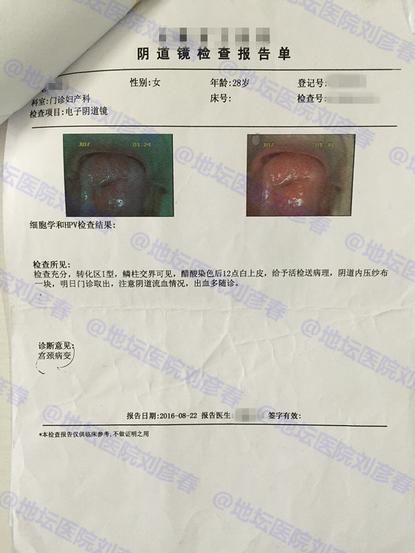 hpv感染引起湿疣或宫颈上皮内病变,高危传染型hpv51