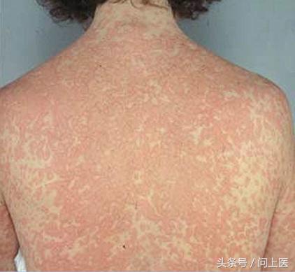 抢救青霉素过敏休克首选的药物是,青霉素过敏休克的急救措施是