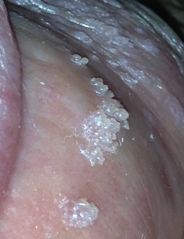 治疗尖锐湿疣要注意这些事情!