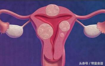 子宫肌瘤一般良性还是恶性肿瘤,子宫肌瘤是良性肿瘤