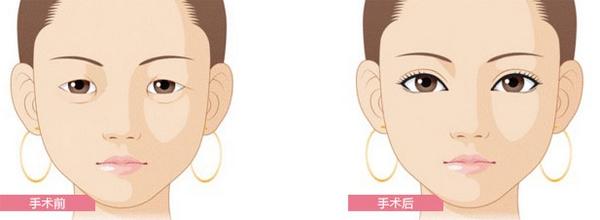 做双眼皮开眼角和不开眼角的区别,想要做双眼皮有什么注意事项吗