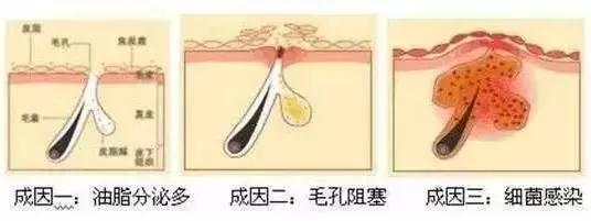 头皮黄金微针效果,头皮上白痘