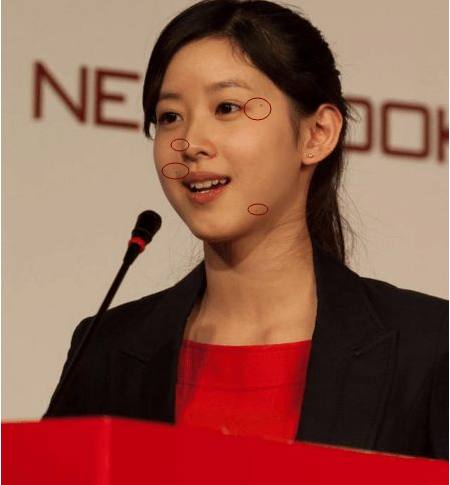 脸上黑痣去不掉，看奶茶妹是这样做的