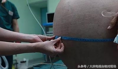 老妇挺“孕肚”负重三载就医成功摘除70斤重盆腔肿物