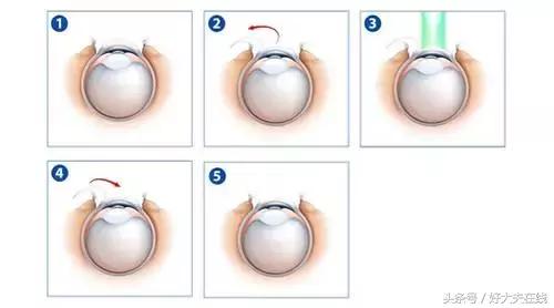 老年人做近视眼手术靠谱吗,4种近视手术哪种好