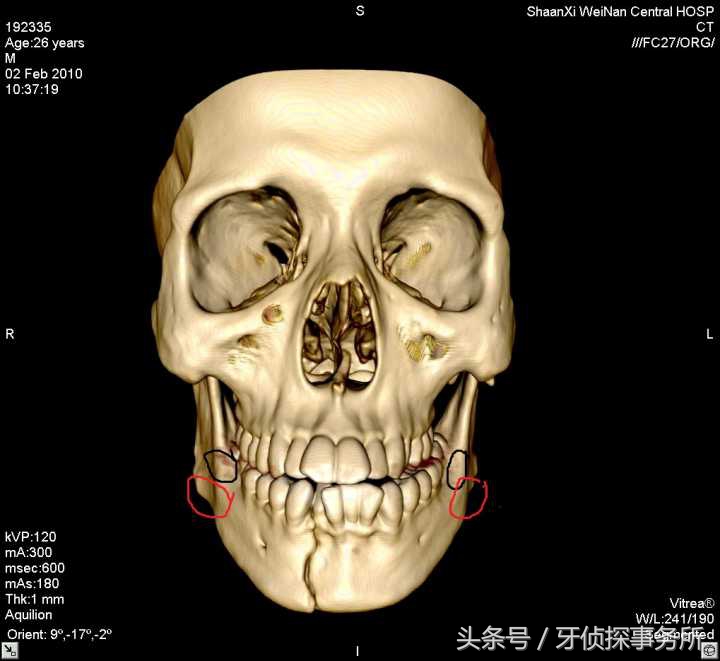 拔牙可以瘦脸轮廓吗,拔牙真的可以瘦脸吗