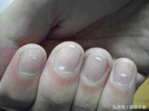 指甲异常色,甲沟炎拔了指甲长出来是灰色指甲