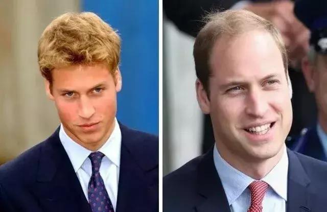 发际线不好看怎么剪,如何拯救90后的发际线