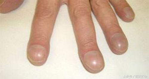 指甲异常色,甲沟炎拔了指甲长出来是灰色指甲