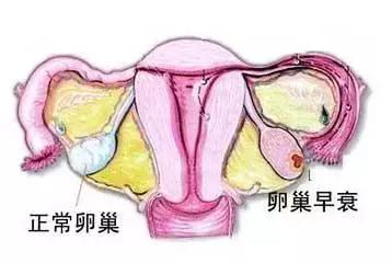 卵巢功能衰退中医讲解,35岁卵巢功能衰退吃什么药