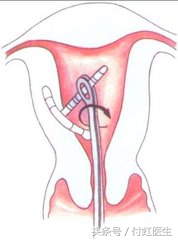 带环一年了小腹经常痛白带有血,白带有血丝和上环有关系