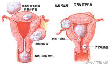 子宫肌瘤一般良性还是恶性肿瘤,子宫肌瘤是良性肿瘤
