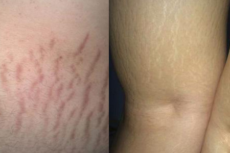 肥胖纹的解决方法,肥胖纹代表胖了还是瘦了