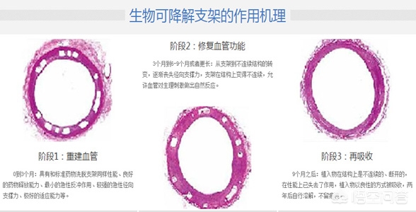 生物可降解支架治疗冠心病好吗,冠心病传统支架和可降解支架