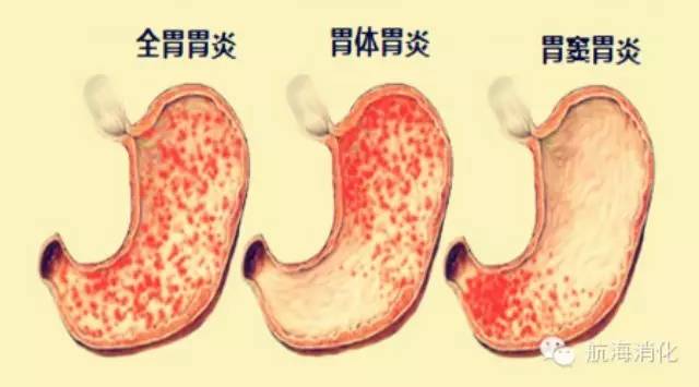 得了胃炎一直消瘦,得了胃炎怎么办呀