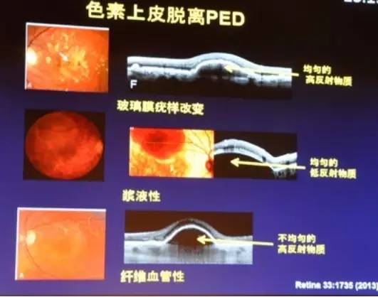 COFDS2016KarlG.Csaky：视网膜色素上皮脱离在干性AMD进展中的影响
