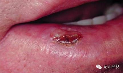 嘴唇肿块是癌症的前兆,嘴唇旁边长一个肿瘤怎么办