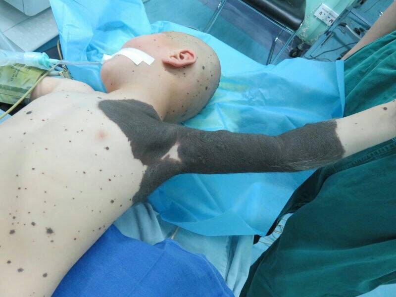 儿童切除黑痣需要全麻吗,先天性巨型兽皮痣能治愈吗