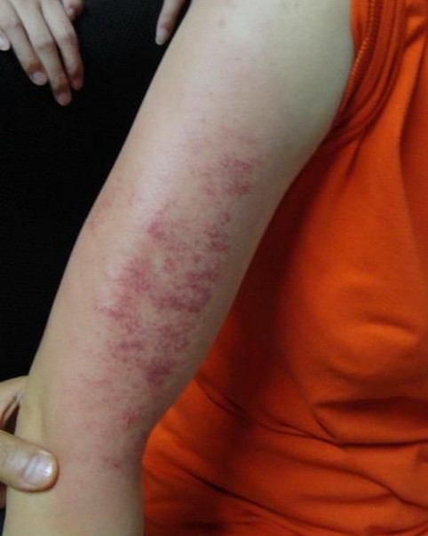 刮痧瘦身真的有效吗,刮痧出来的痧是血管破了吗