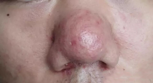 酒渣鼻怎么改善学生党,酒渣鼻严重怎么彻底治疗