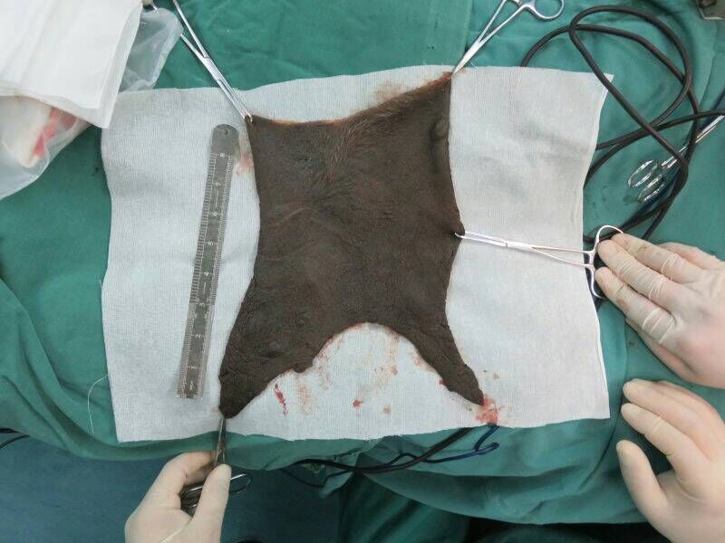 儿童切除黑痣需要全麻吗,先天性巨型兽皮痣能治愈吗