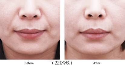 有一种增龄神器叫法令纹