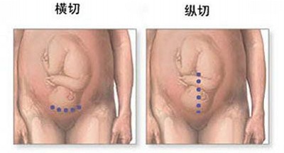 剖宫产分娩选择,剖腹产和顺产到底该如何选择