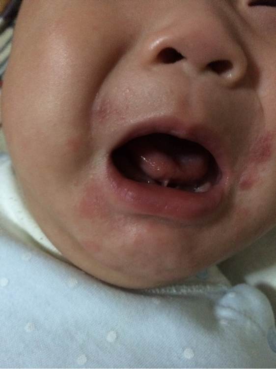 6个月宝宝嘴边眼睛周围有湿疹,6个月的宝宝嘴边起湿疹怎么办