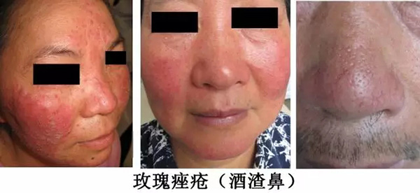 酒渣鼻怎么改善学生党,酒渣鼻严重怎么彻底治疗